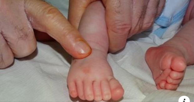 Бебче с шест пръста се роди в бургаска болница, родителите в шок