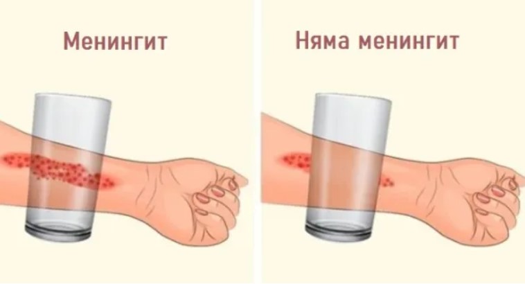 8 симптома на менингит, които всеки родител трябва да знае
